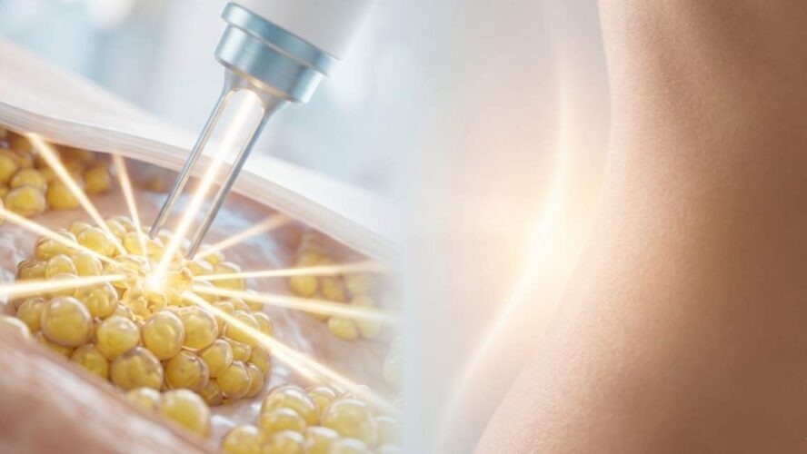Cos’è davvero la liposuzione laser e perché oggi è così richiesta